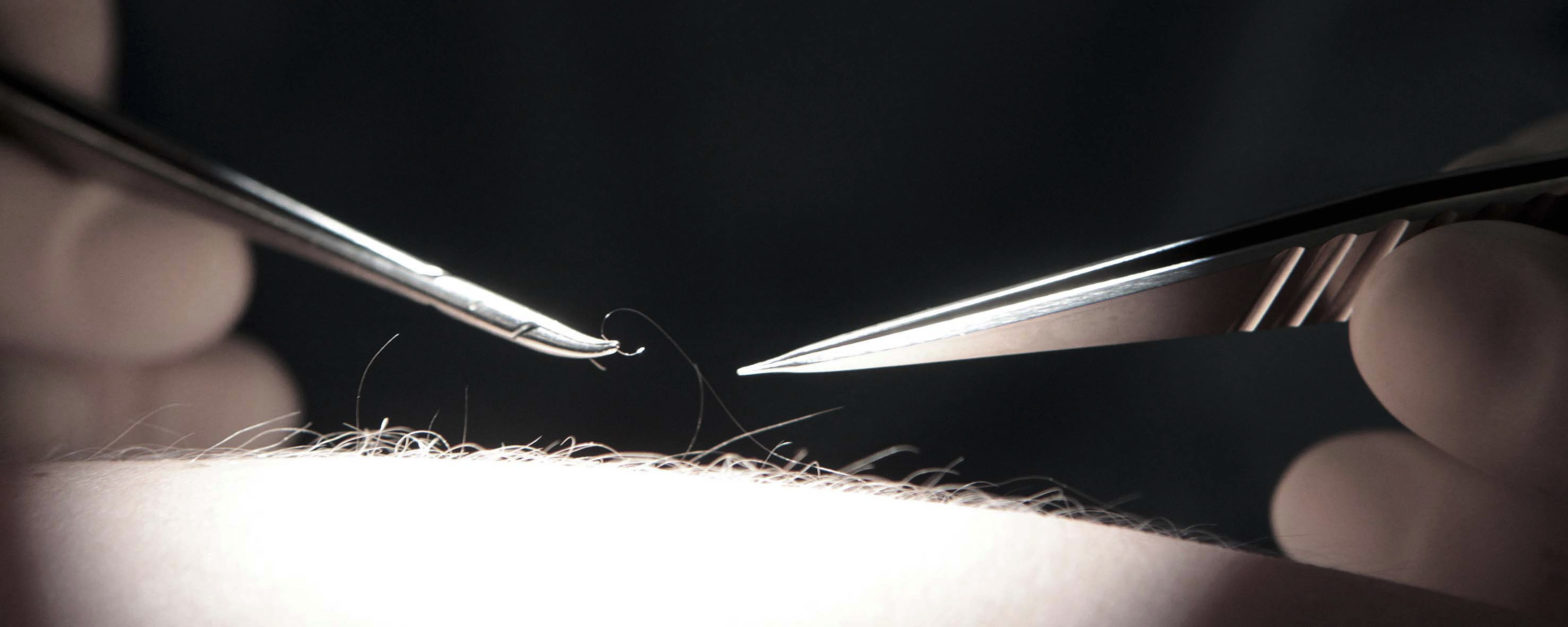 Lymphchirurgie Düsseldorf bei Lymphödem Lymphchirurgie Düsseldorf